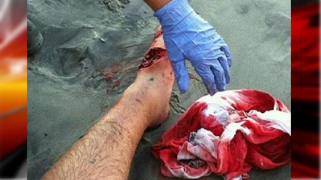 GRAPHIC: Shark Bites Swimmer Near Myrtle Beach – OUCH! #SurfReport